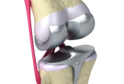 knee-prosthesis